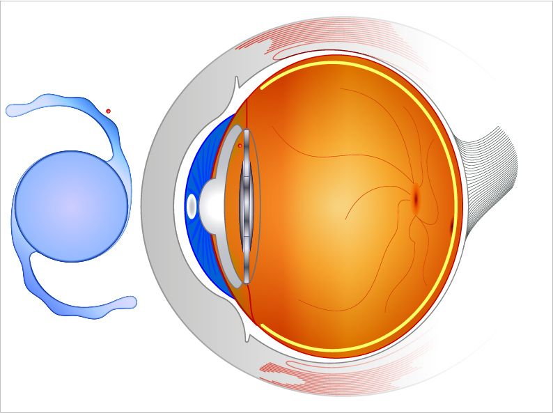 Choosing the Right Premium IOL for Your Cataract Surgery: Factors to Consider