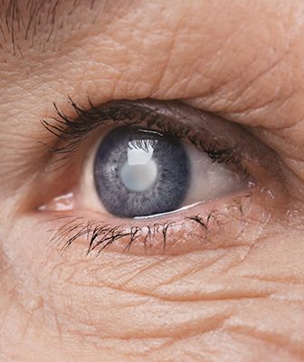 Premium Cataract Surgery