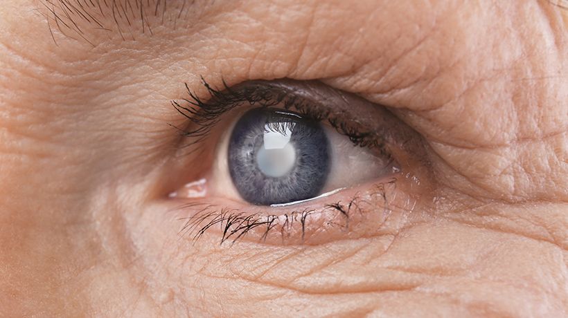 Premium Cataract Surgery