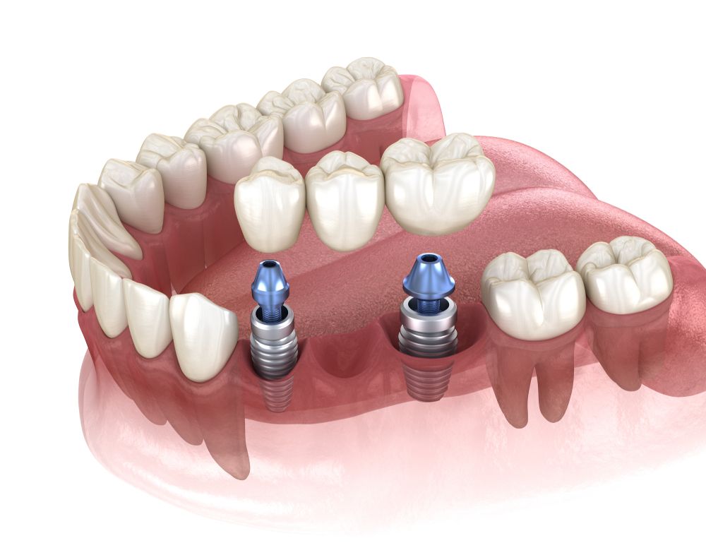 Understanding Bridges on Implants: How They Work and Their Advantages Over Traditional Bridges