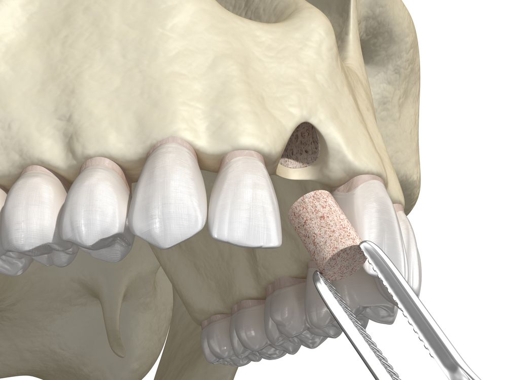 What Are the Benefits of Bone Grafts?