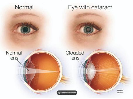 Cataract Awareness