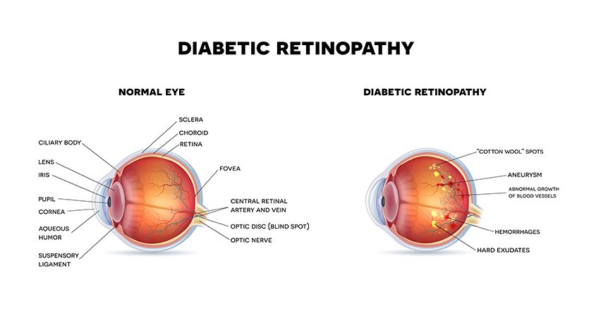 Diabetic Retinopathy