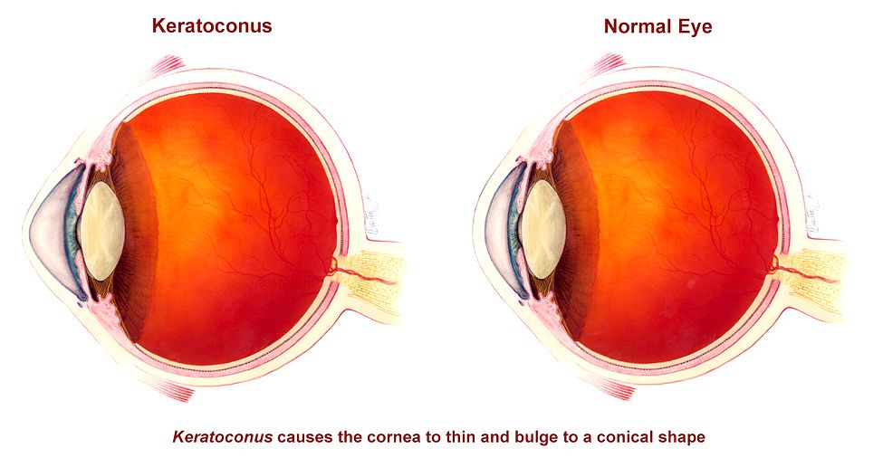 Keratoconus