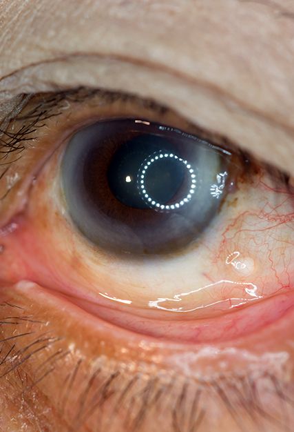 Diabetic Retinopathy