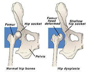 hip dysplasia