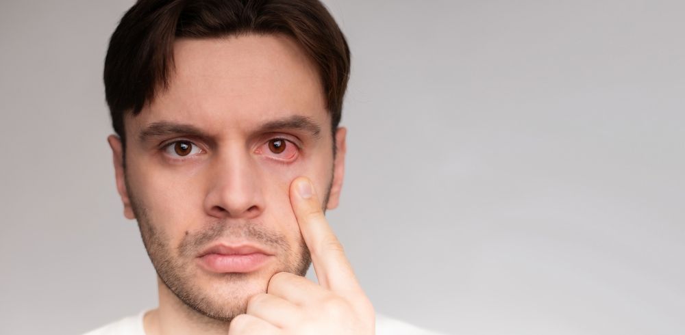 Dry Eye: Signs, Symptoms, and Effective Treatment Methods
