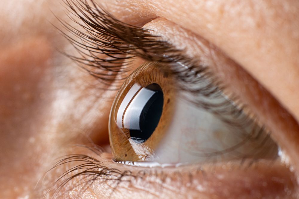 Keratoconus: Understanding the Condition and Finding the Right Treatment