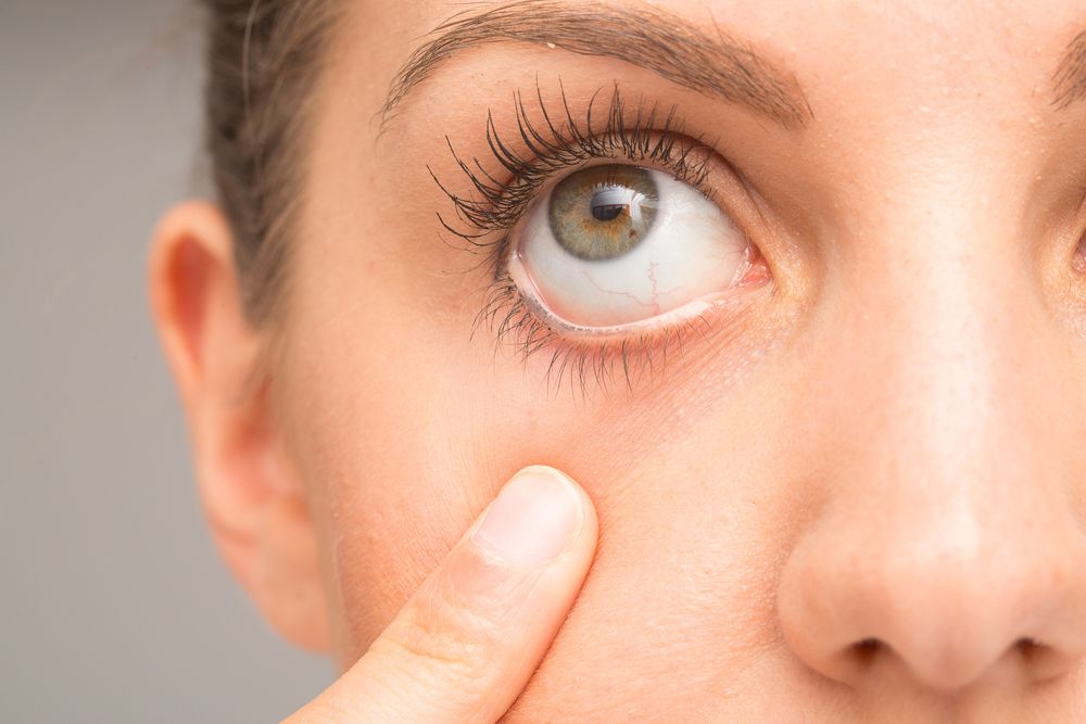 Dry Eye and Contact Lenses: Tips for Safe and Comfortable Wear