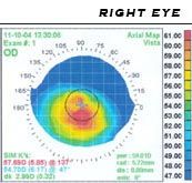 eye map