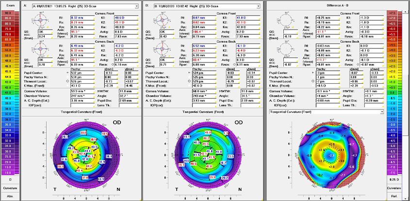 ortho k near me Correct Vision Problems with Non-Invasive Treatment