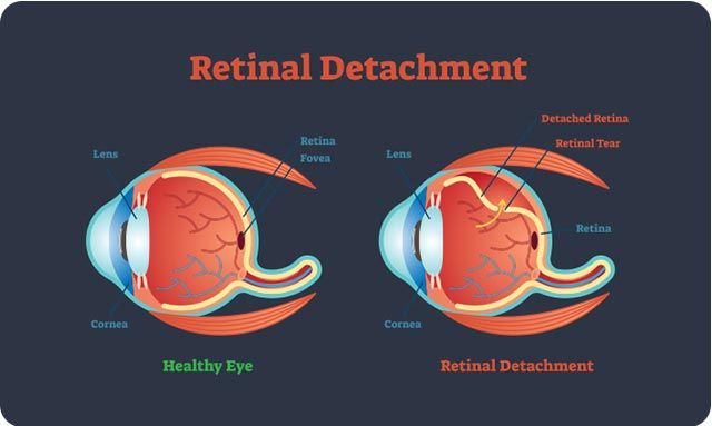 What is Retinal Detachment and How to Treat It