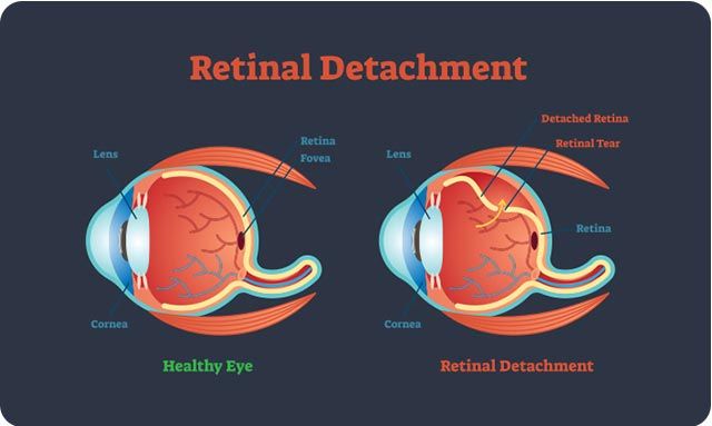 Can You Prevent and Treat Retinal Detachment?