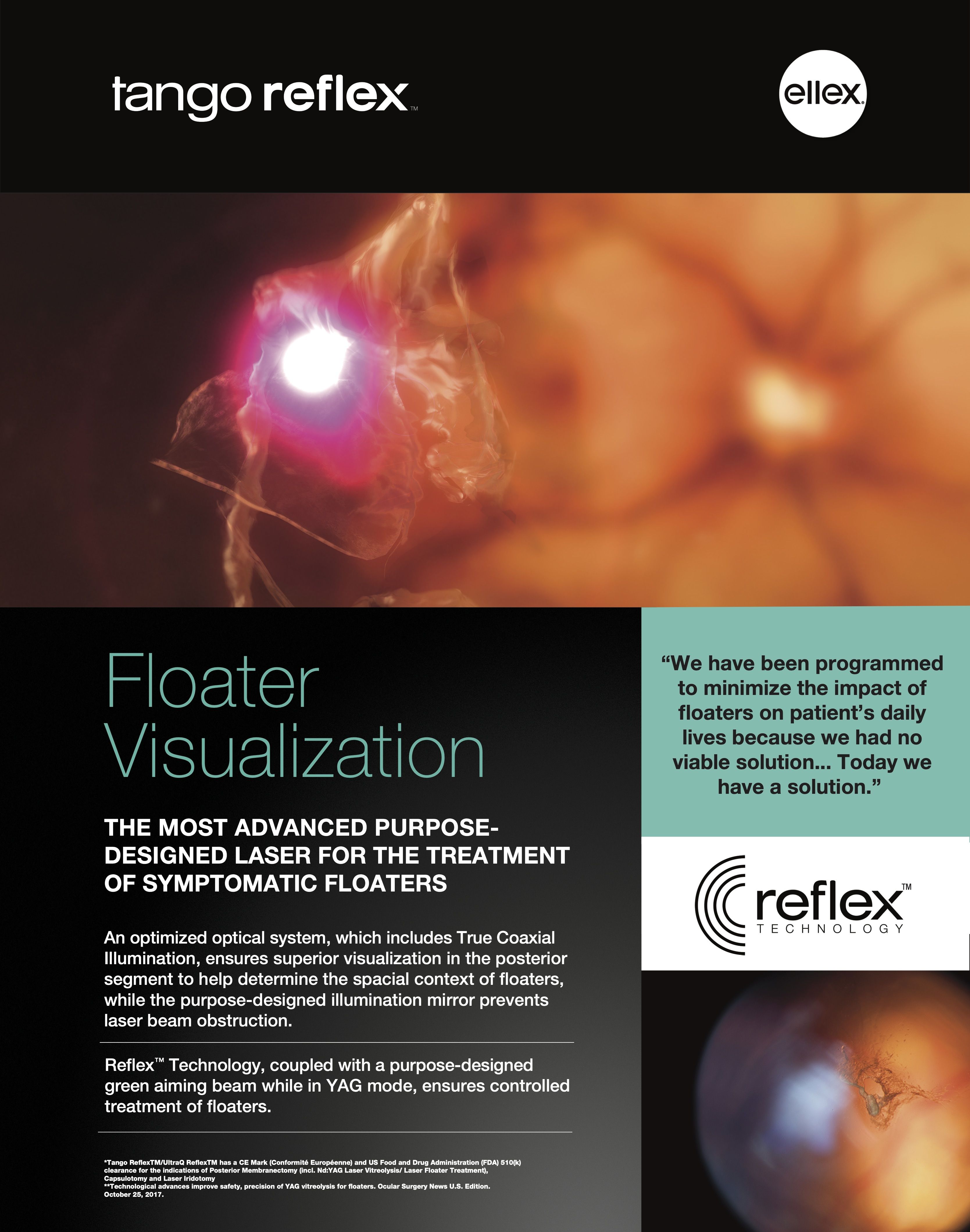 YAG Laser Floater Removal