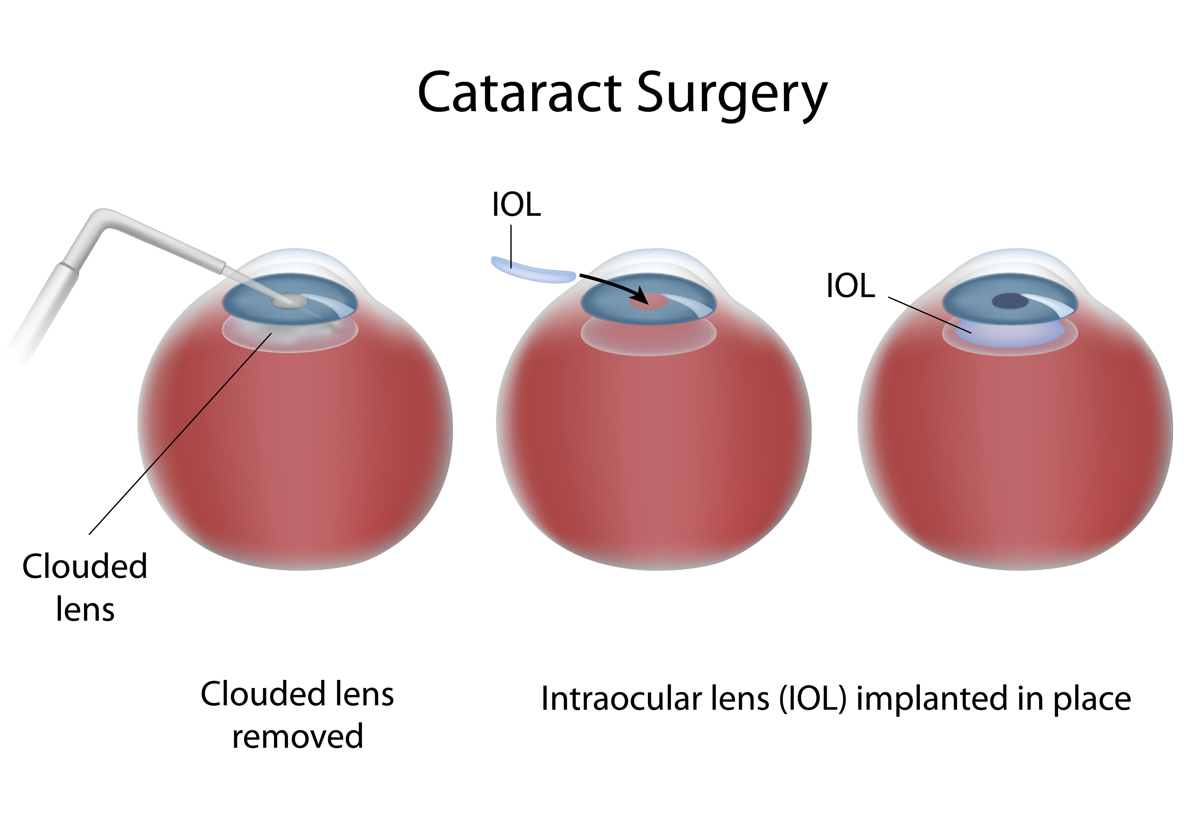 Diagram of a cataract surgery