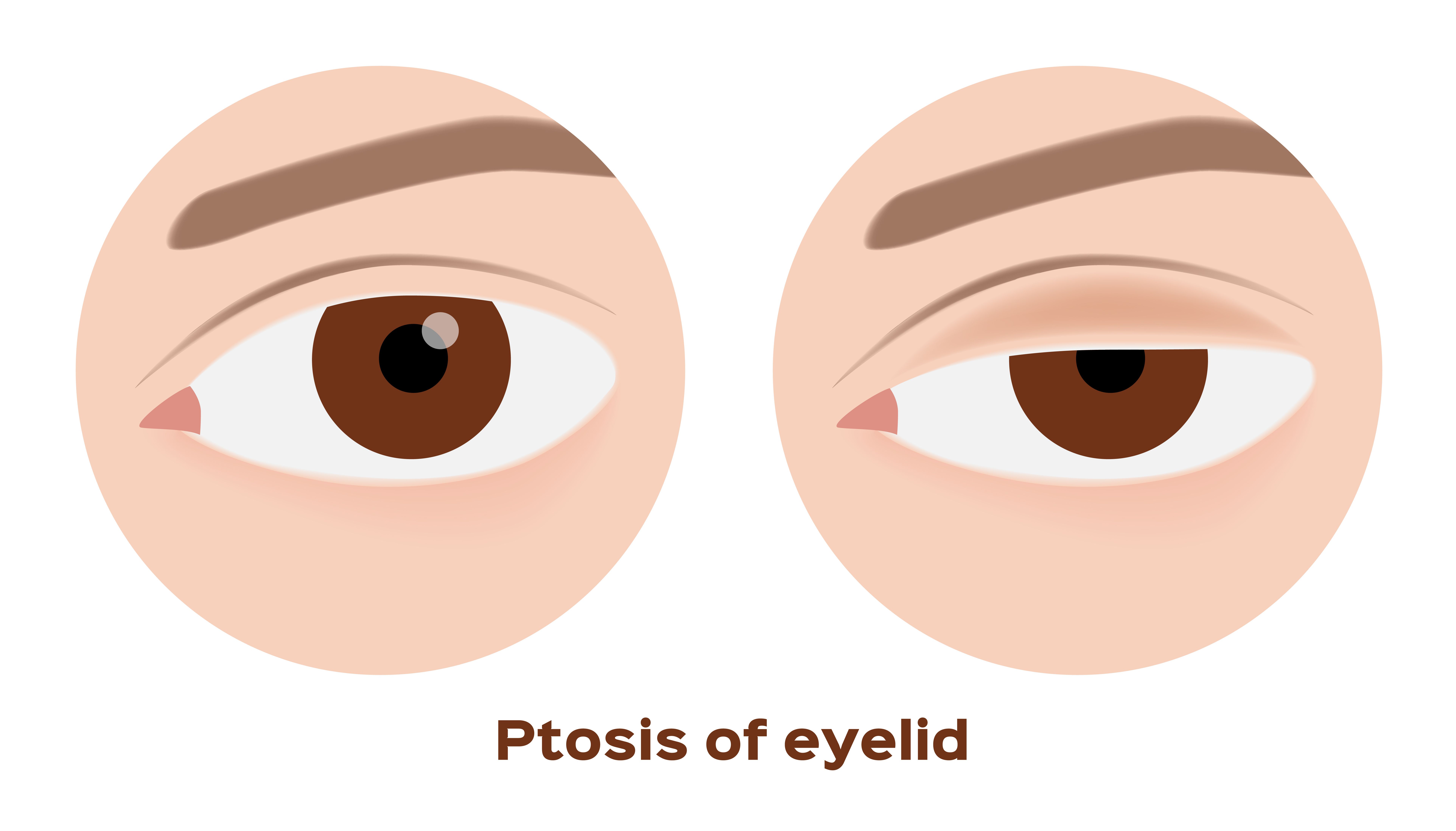 ptosis