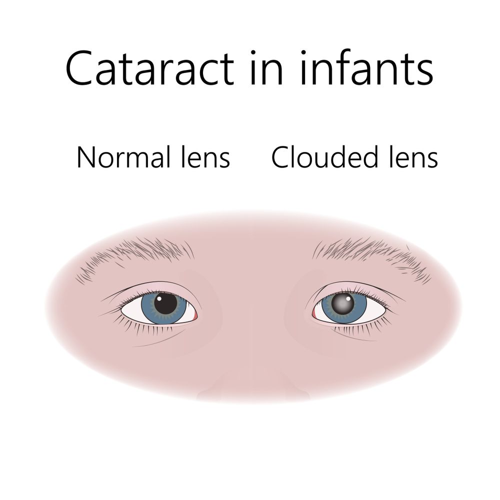 congenital cataracts