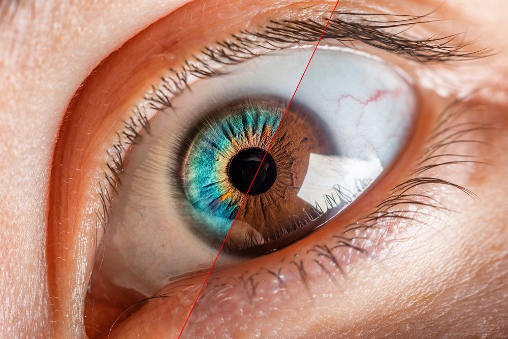 corneal hypoxia