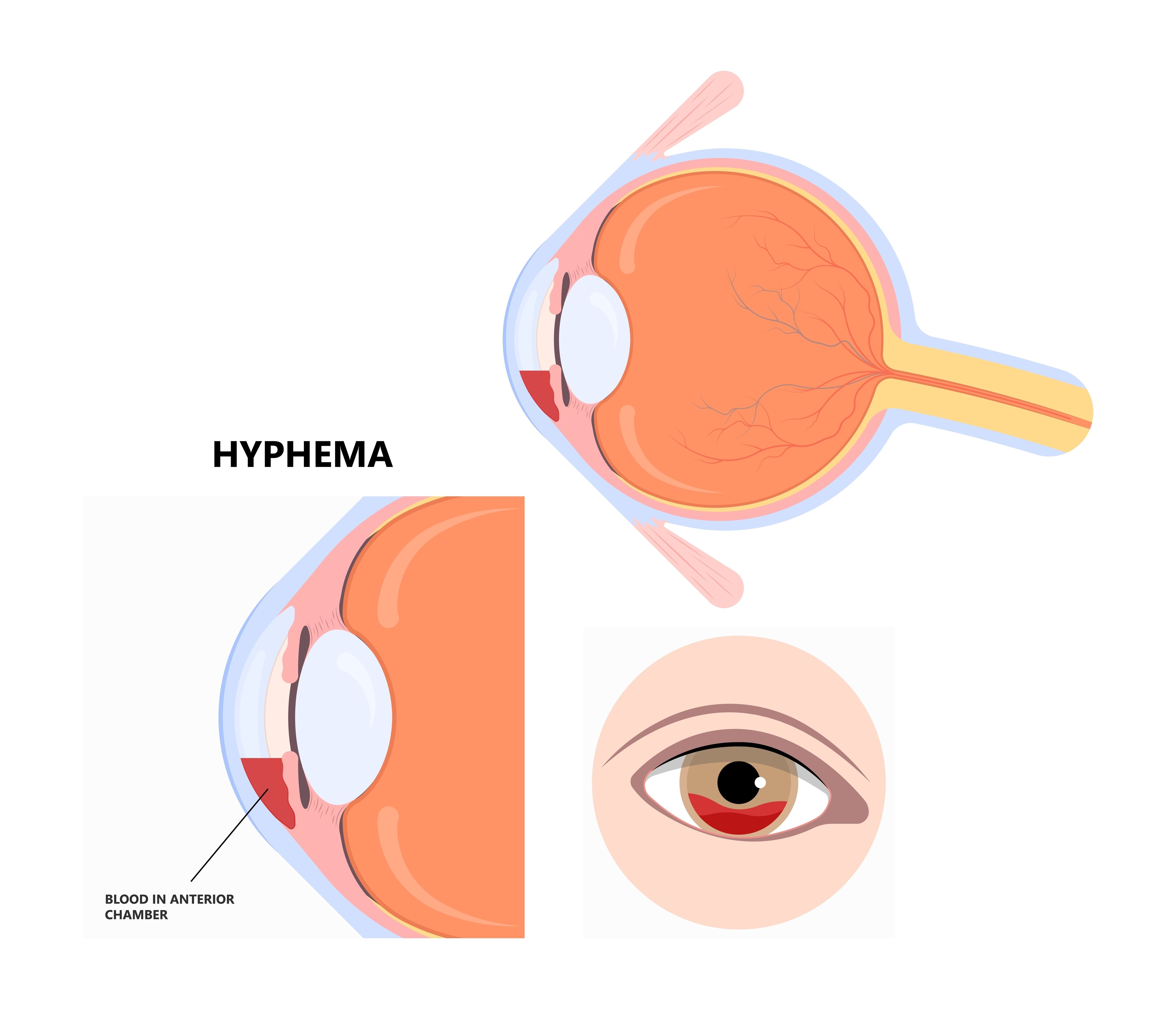 hyphema diagram