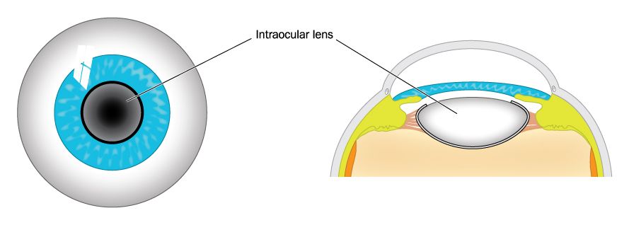 intraocular lenses