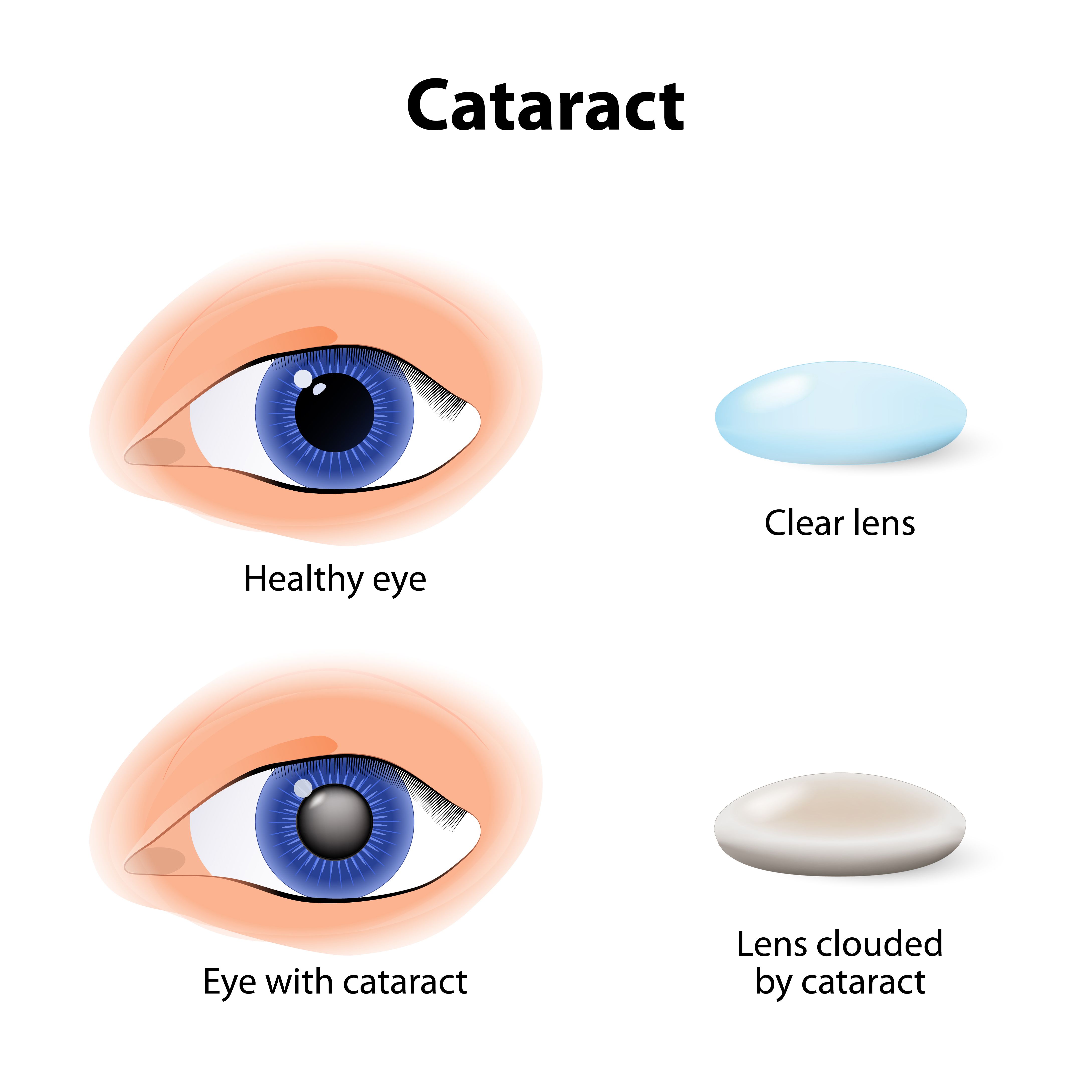 Diagram of a cataract