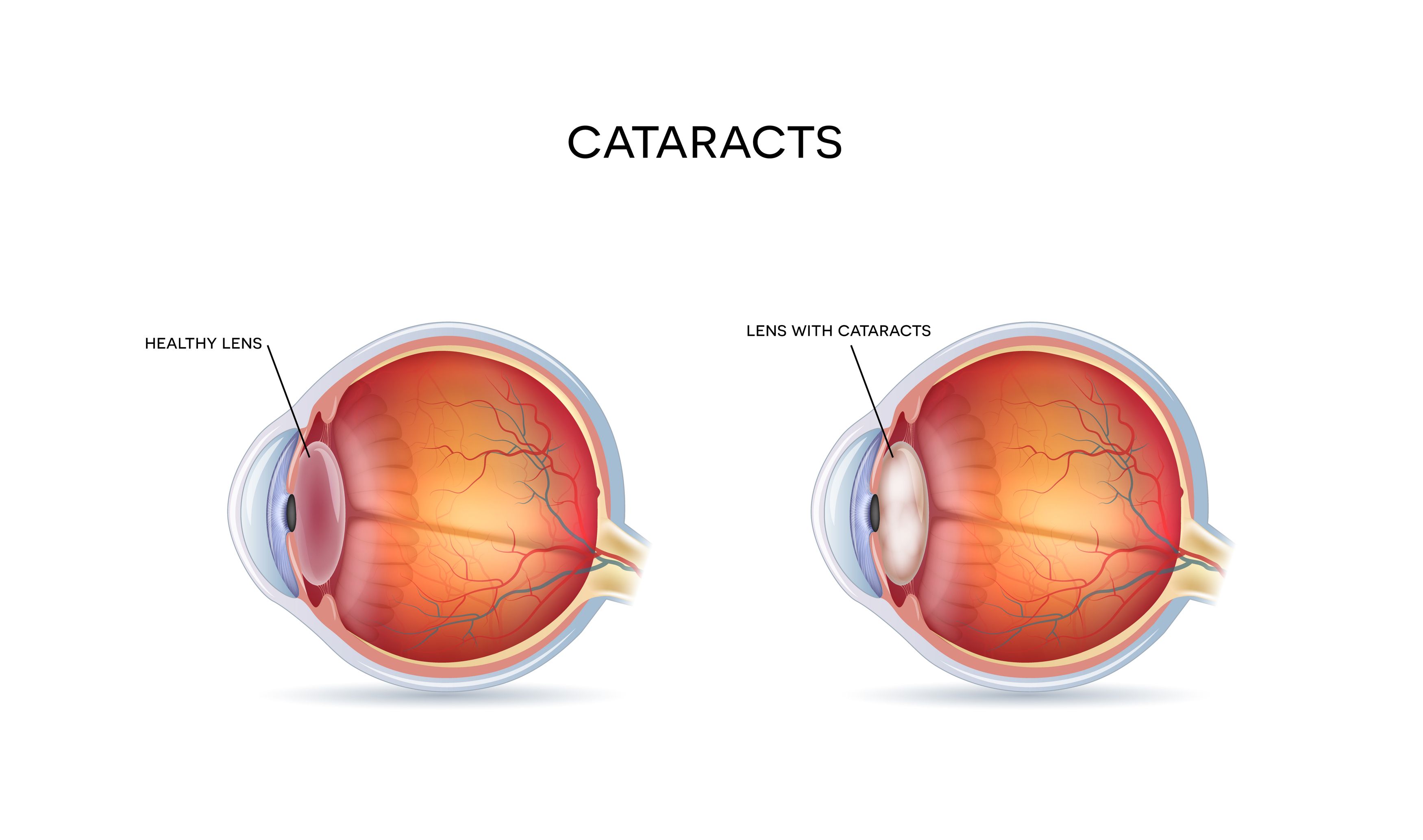 Diagram of a cataract