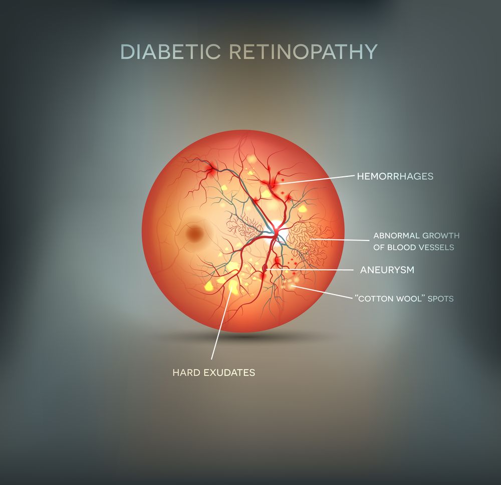 Diabetic Eye Screening