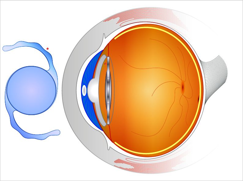intraocular lenses