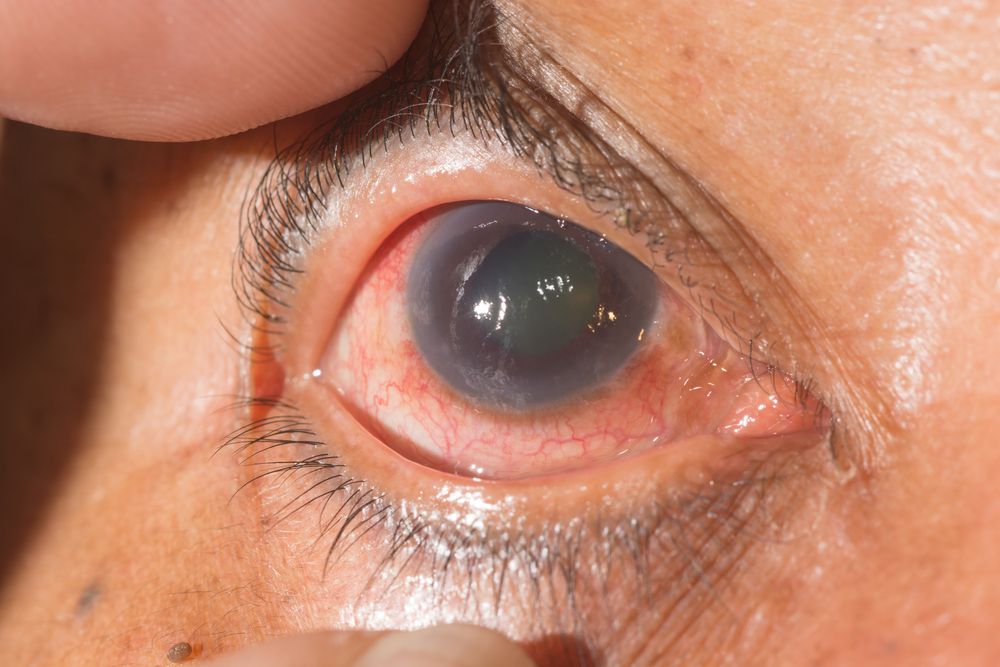 red eyes form glaucoma
