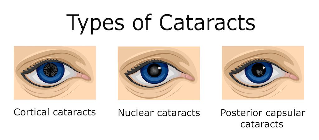 types of cataracts