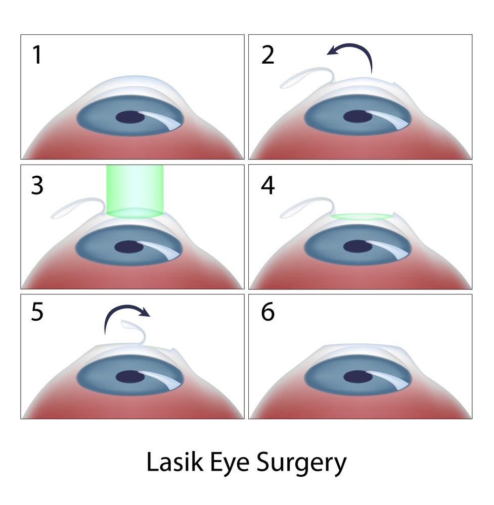 LASIK eye surgery