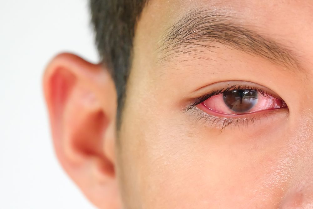The young man has red eye inflammation,red eye, Conjunctivitis or irritation of sensitive eyes.