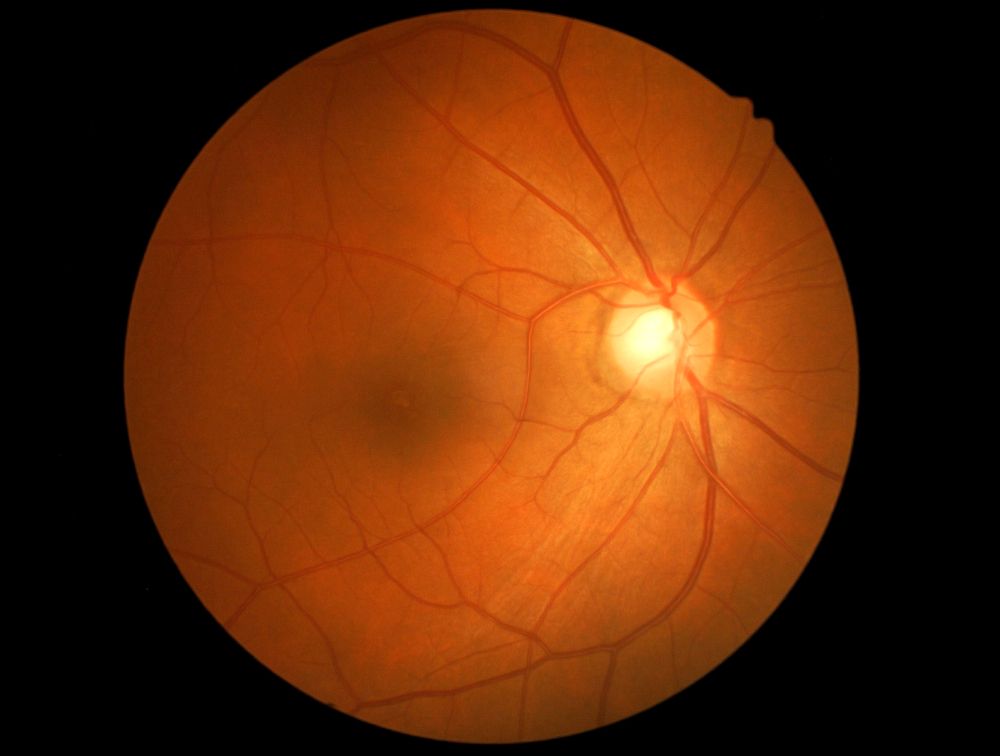 retinal exam