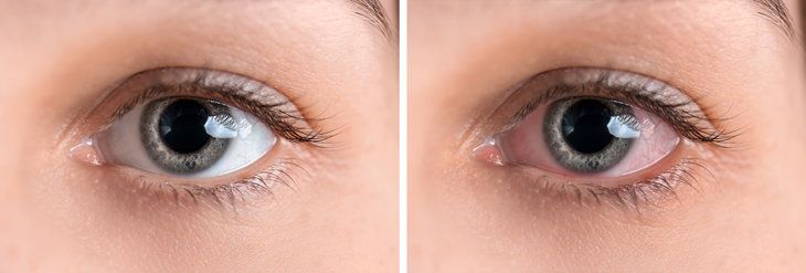 UVEITIS