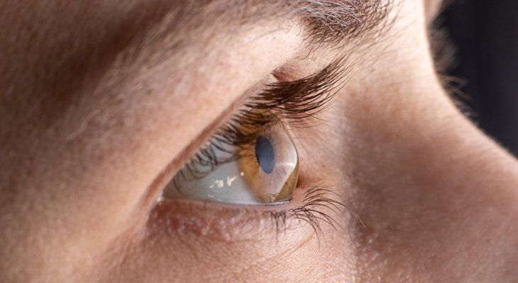 KERATOCONUS