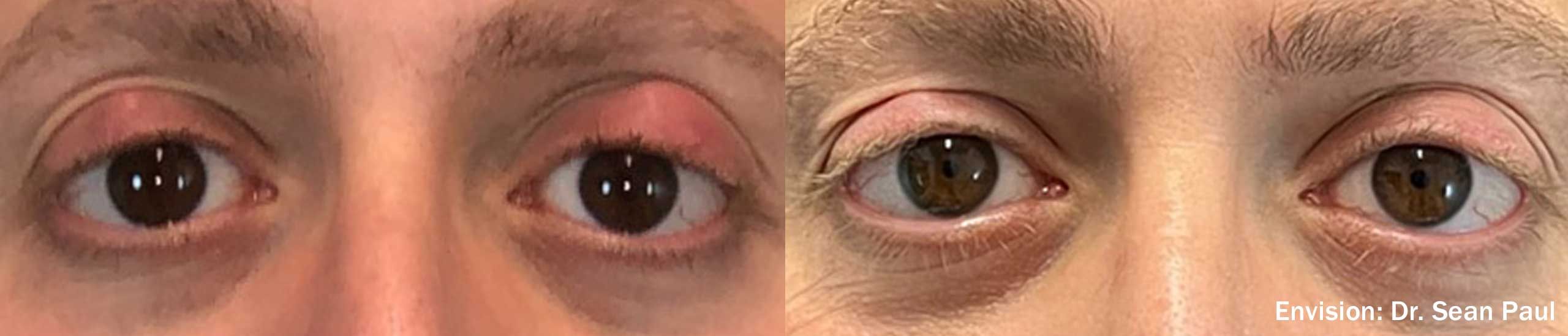 FormaI Radio Frequency (RF) Treatment At Optic Gallery Fort Apache in