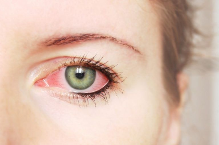 Pink Eye Symptoms and Treatment