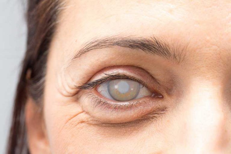 Symptoms and Treatment For Cataracts