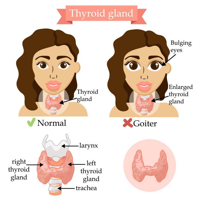 Thyroid Eye Disease