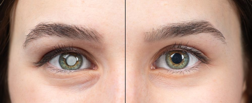 Macro of the eye of a young woman with and without cataracts. Simulation of before and after cataract removal surgery to avoid blindness