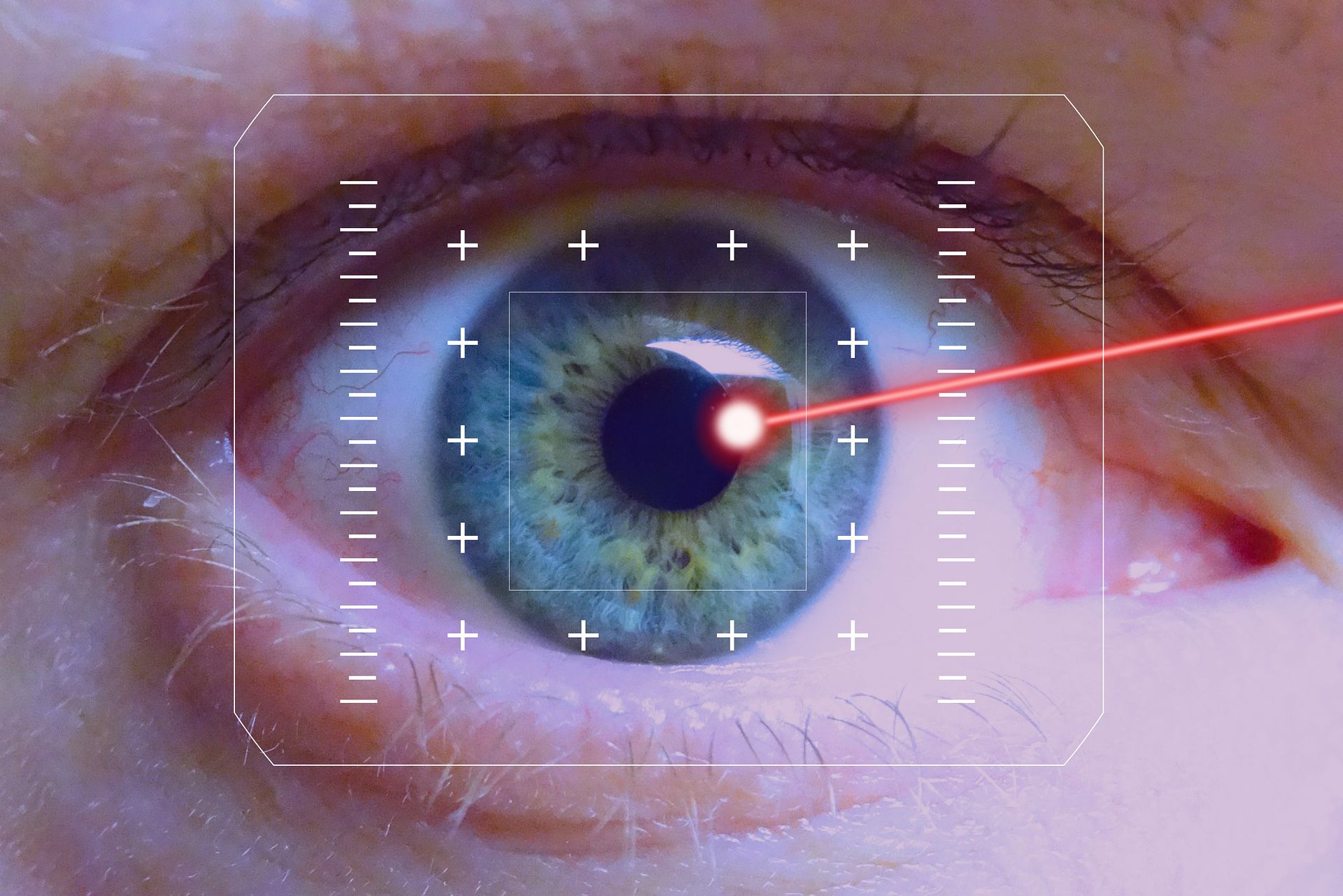 lasik surgery