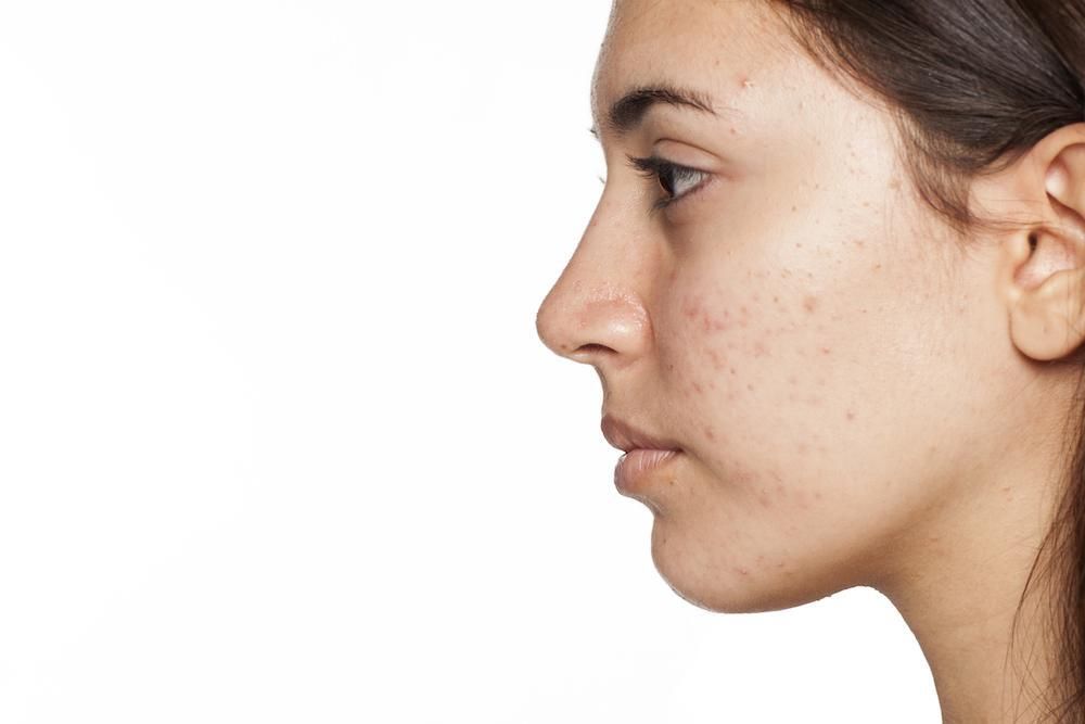 Why Do I Still Get Acne and How Can I Get Rid of It?