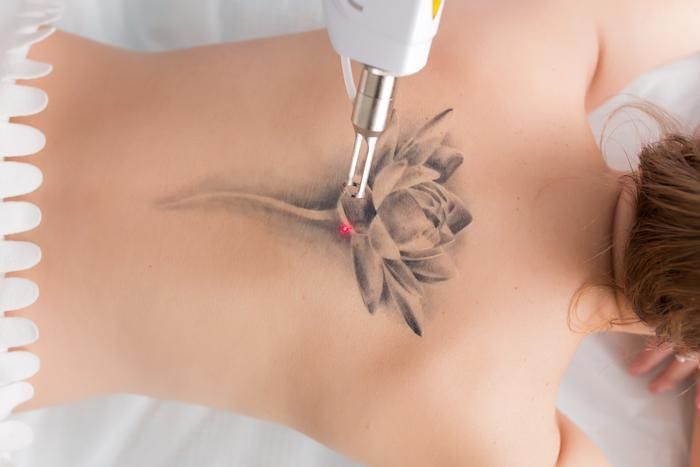 How Does Tattoo Removal Actually Work?