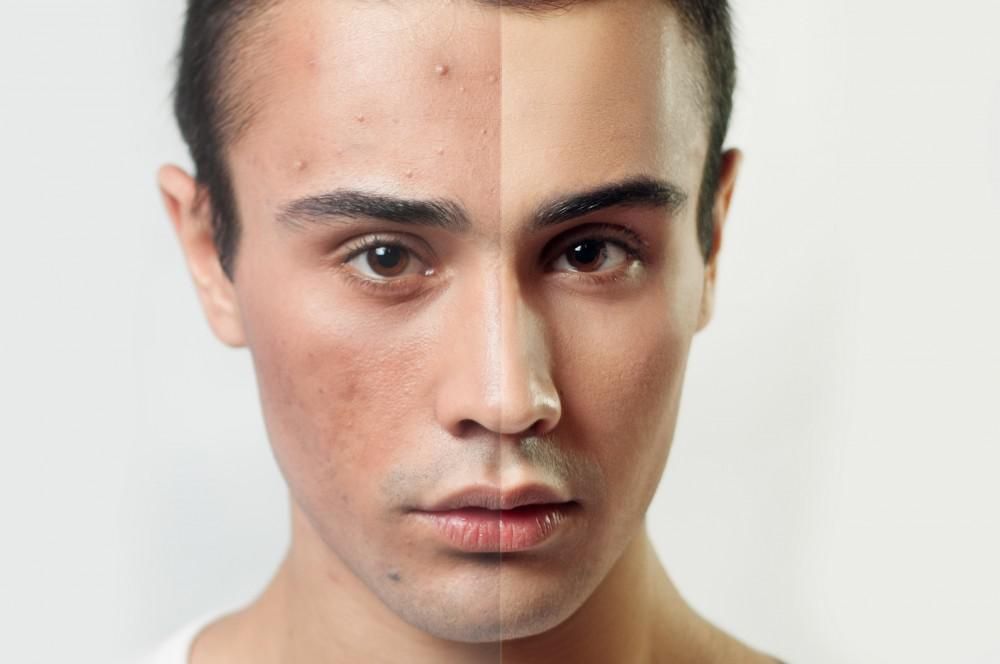 You Don't Have to Live with Acne Scars: Here's How to Get Rid of Them