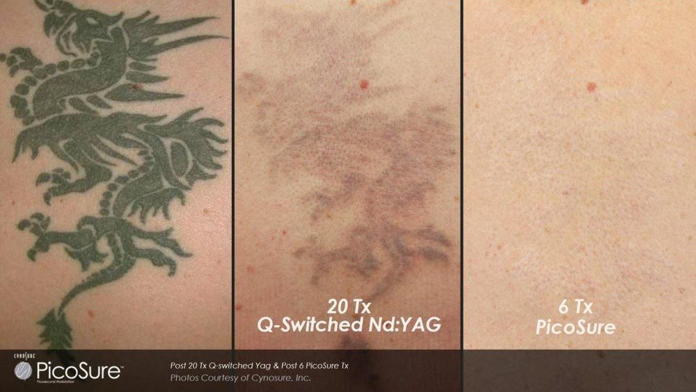 Is PicoSure Tattoo Removal Right for You?