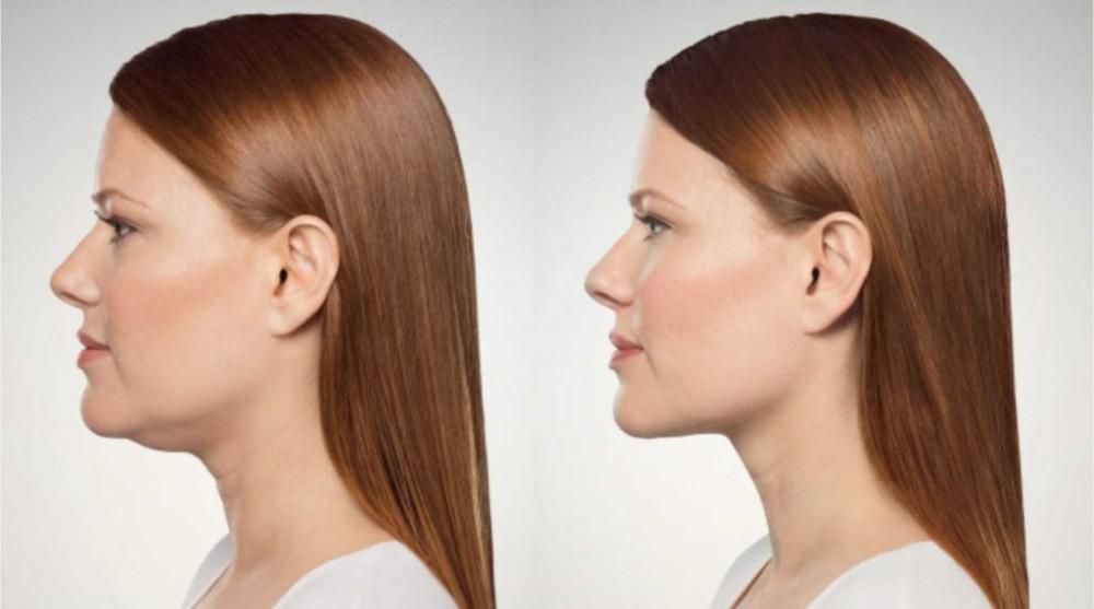 New Treatment to Remove Fat Under the Chin