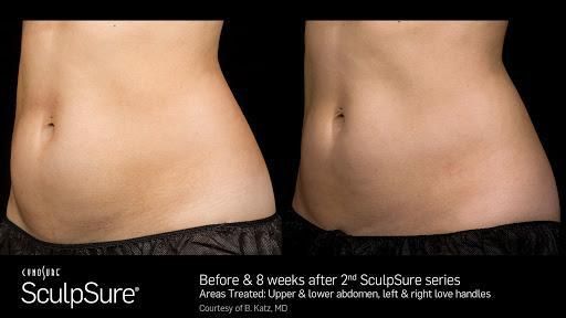 Considering Lipo in Fort Worth? Try WarmSculpting with SculpSure Instead!