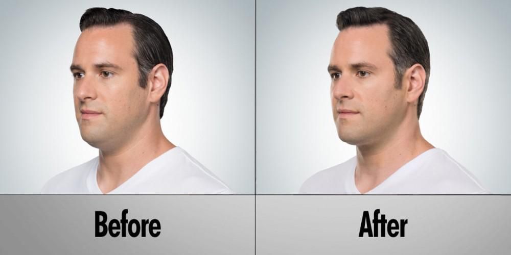 Got a Double Chin? Try Out Kybella