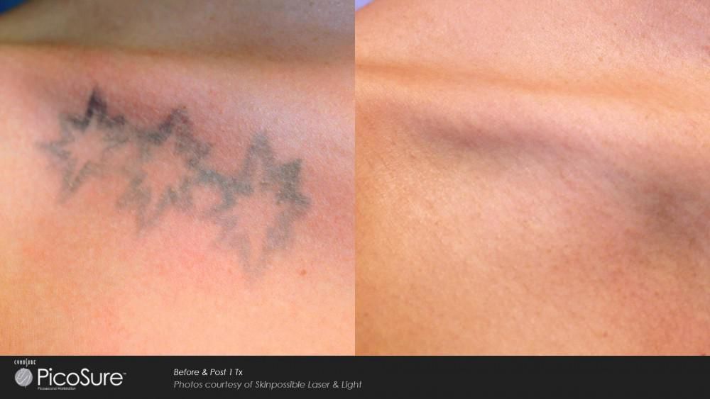 Eliminate Your Old Tattoo with Laser Tattoo Removal