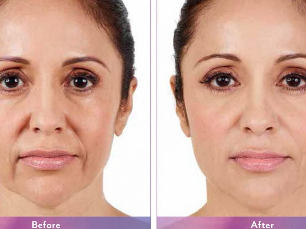Improve Your Appearance with Juvederm